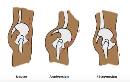 Schéma expliquant la différence entre position neutre, antéversion et rétroversion du bassin